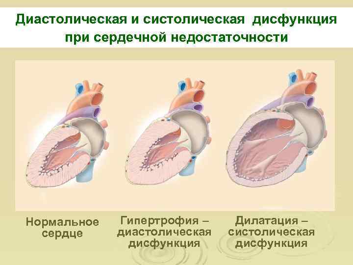 Диастолическая и систолическая дисфункция при сердечной недостаточности Нормальное сердце Гипертрофия – диастолическая дисфункция Дилатация