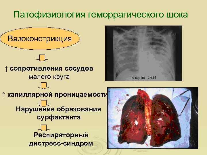 Патофизиология геморрагического шока Вазоконстрикция ↑ сопротивления сосудов малого круга ↑ капиллярной проницаемости Нарушение образования