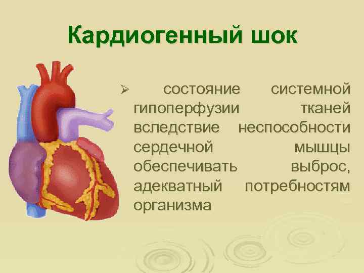 Кардиогенный шок Ø состояние системной гипоперфузии тканей вследствие неспособности сердечной мышцы обеспечивать выброс, адекватный