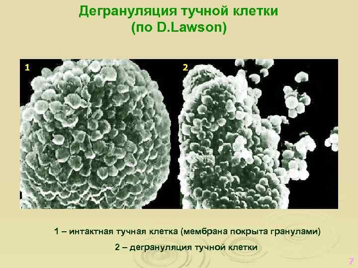 Дегрануляция тучной клетки (по D. Lawson) 1 2 1 – интактная тучная клетка (мембрана