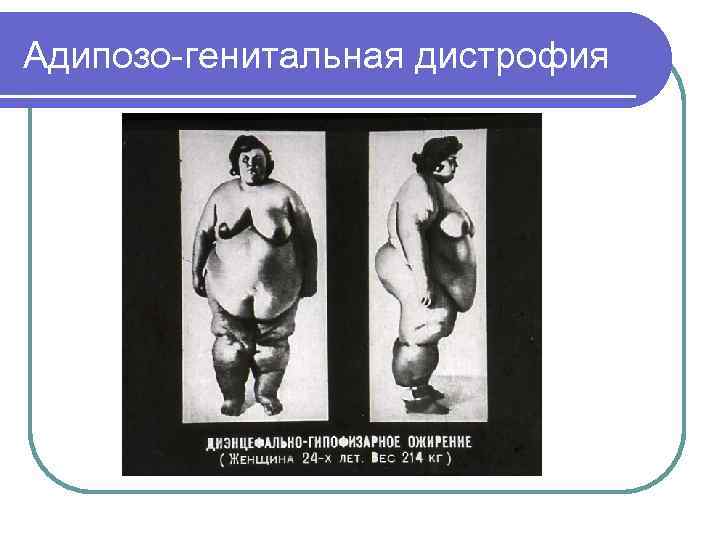 Адипозо-генитальная дистрофия 