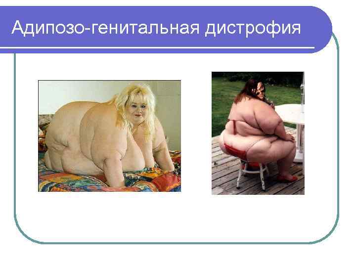 Адипозо-генитальная дистрофия 
