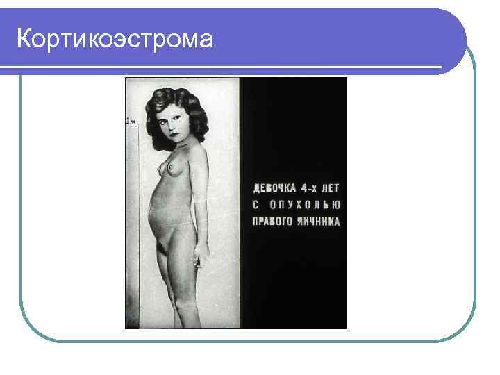 Кортикоэстрома 