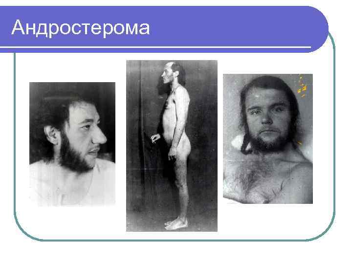 Андростерома 