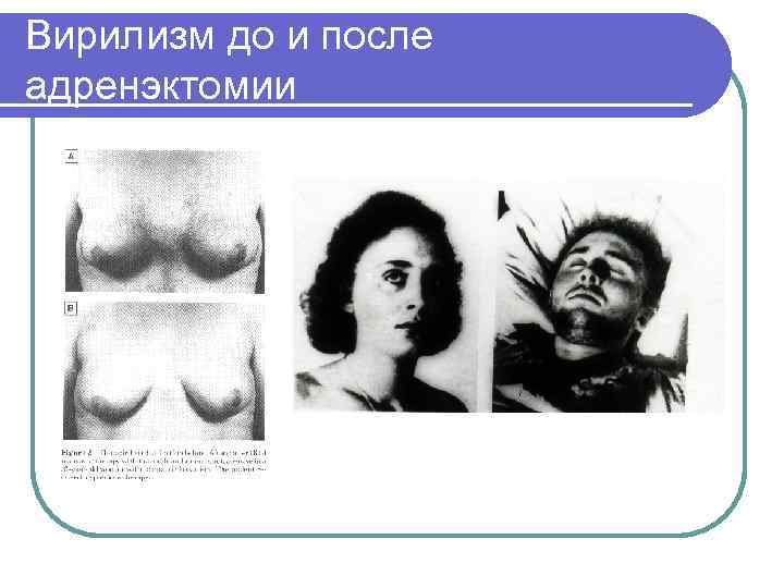 Вирилизм до и после адренэктомии 