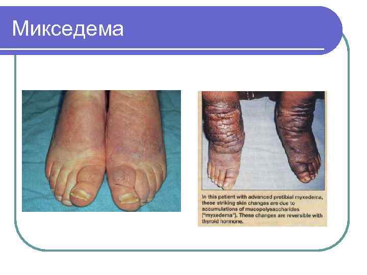 Микседема 