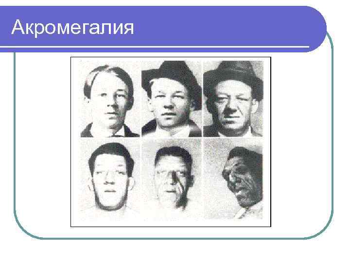 Акромегалия 