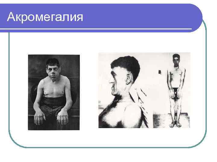 Акромегалия 