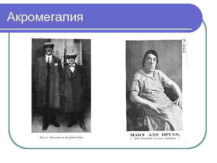 Акромегалия 