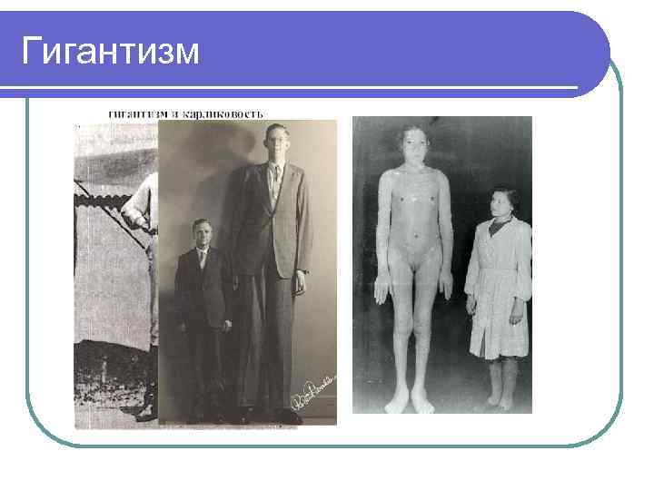 Гигантизм 