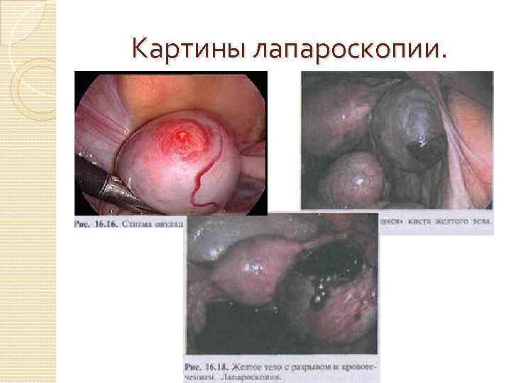 Картины лапароскопии. 
