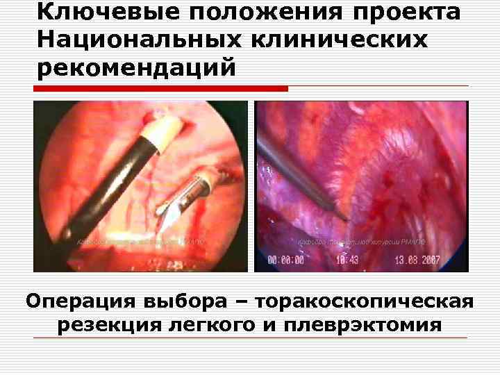 Ключевые положения проекта Национальных клинических рекомендаций Операция выбора – торакоскопическая резекция легкого и плеврэктомия