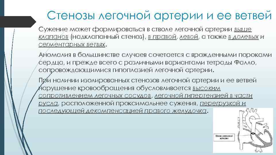 Стенозы легочной артерии и ее ветвей Сужение может формироваться в стволе легочной артерии выше