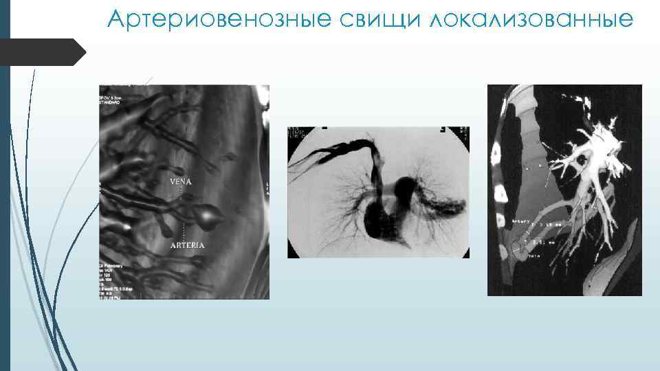 Артериовенозные свищи локализованные 