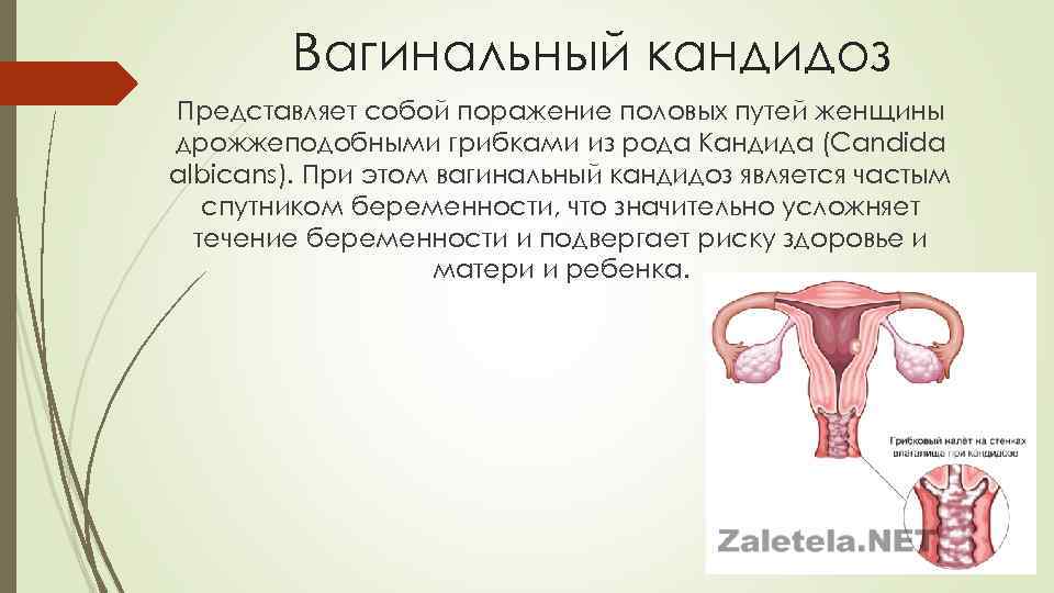 Вагинальный кандидоз Представляет собой поражение половых путей женщины дрожжеподобными грибками из рода Кандида (Candida