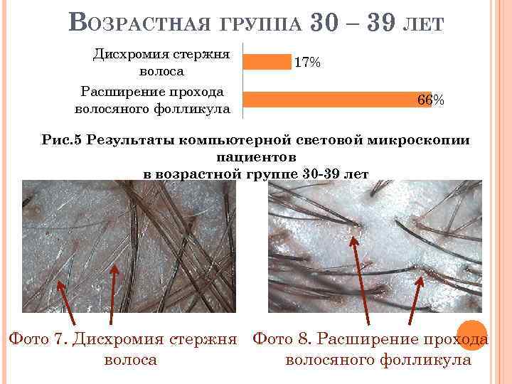 ВОЗРАСТНАЯ ГРУППА 30 – 39 ЛЕТ Дисхромия стержня волоса Расширение прохода волосяного фолликула 17%