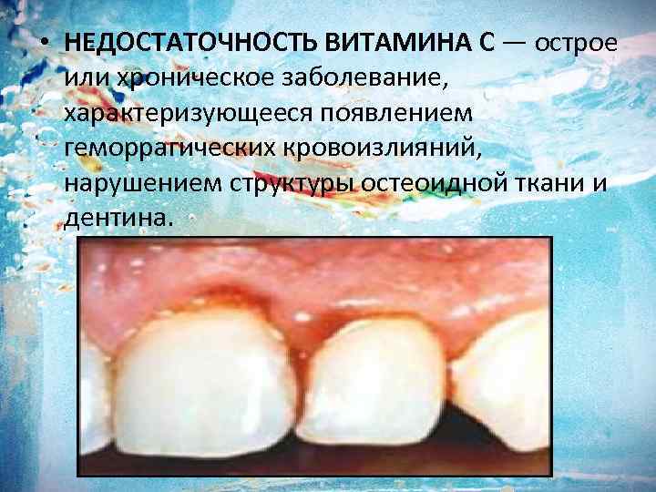  • НЕДОСТАТОЧНОСТЬ ВИТАМИНА С — острое или хроническое заболевание, характеризующееся появлением геморрагических кровоизлияний,