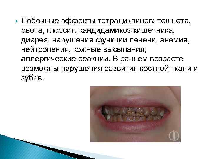  Побочные эффекты тетрациклинов: тошнота, рвота, глоссит, кандидамикоз кишечника, диарея, нарушения функции печени, анемия,