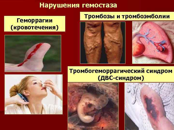 Нарушения гемостаза Геморрагии (кровотечения) Тромбозы и тромбоэмболии Тромбогеморрагический синдром (ДВС-синдром) 