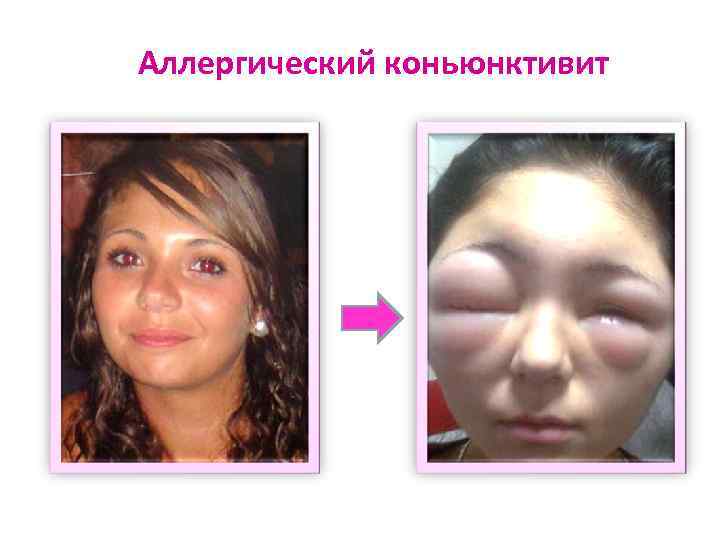 Аллергический коньюнктивит 