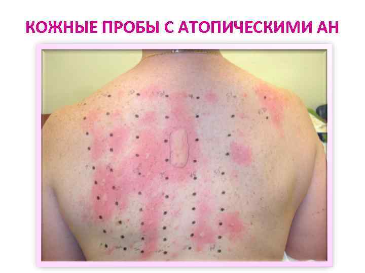 КОЖНЫЕ ПРОБЫ С АТОПИЧЕСКИМИ АН 
