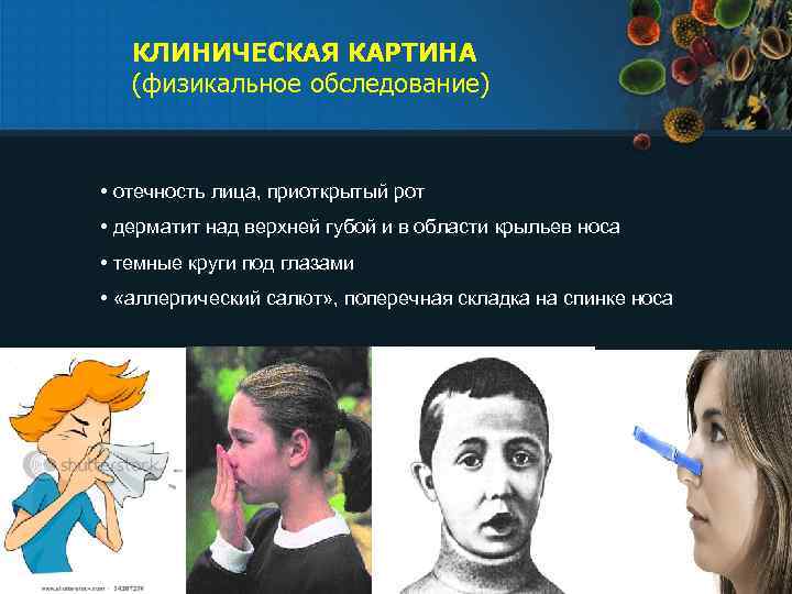 КЛИНИЧЕСКАЯ КАРТИНА (физикальное обследование) • отечность лица, приоткрытый рот • дерматит над верхней губой