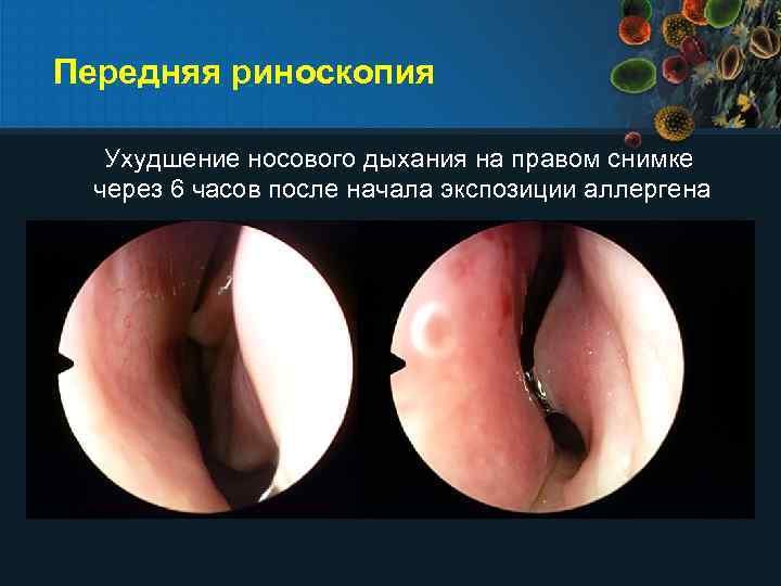 Передняя риноскопия Ухудшение носового дыхания на правом снимке через 6 часов после начала экспозиции
