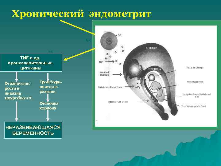 Хронический эндометрит СD 56 NK NK TNF и др. провоспалительные цитокины Ограничение роста и