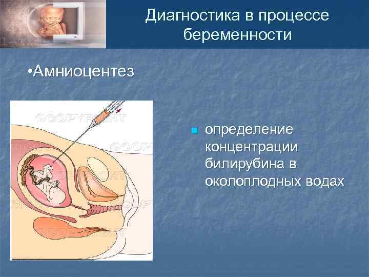 Диагностика в процессе беременности • Амниоцентез n определение концентрации билирубина в околоплодных водах 