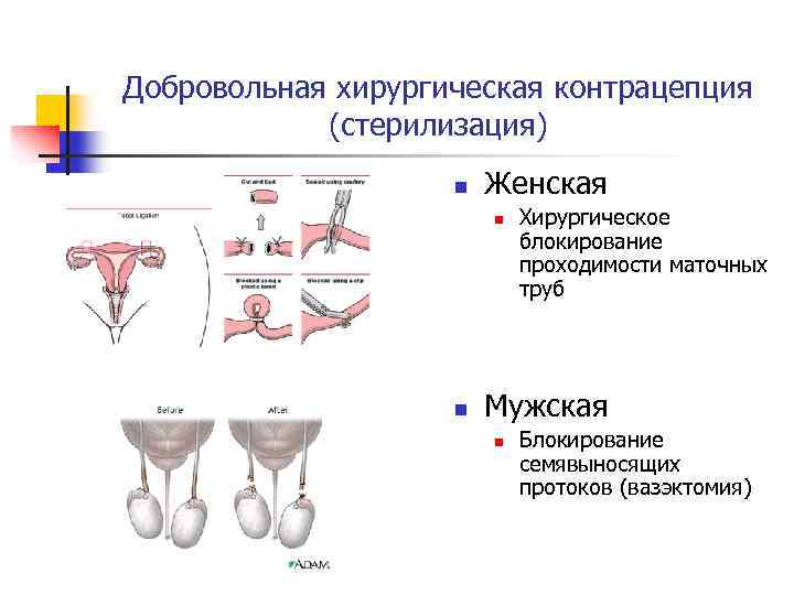 Добровольная хирургическая контрацепция (стерилизация) n Женская n n Хирургическое блокирование проходимости маточных труб Мужская