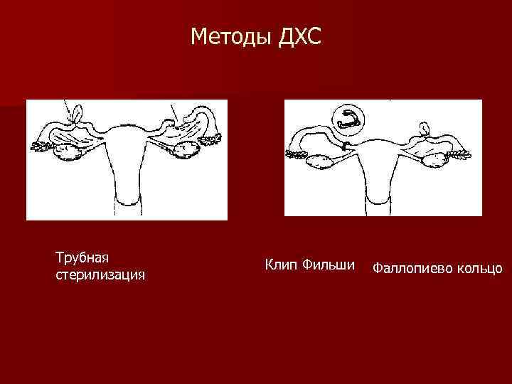 Добровольная хирургическая стерилизация презентация