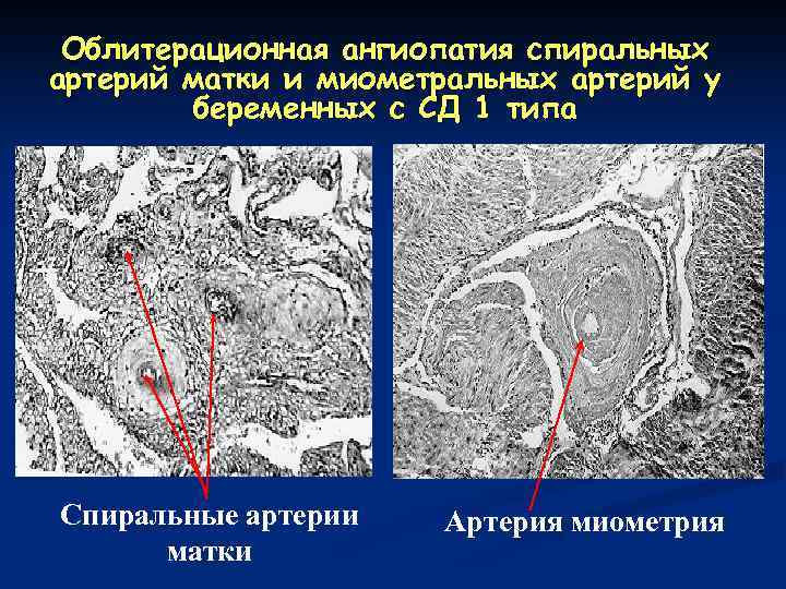 Облитерационная ангиопатия спиральных артерий матки и миометральных артерий у беременных с СД 1 типа