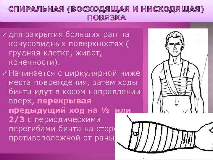 СПИРАЛЬНАЯ (ВОСХОДЯЩАЯ И НИСХОДЯЩАЯ) ПОВЯЗКА для закрытия больших ран на конусовидных поверхностях ( грудная