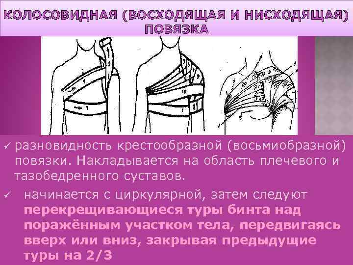 КОЛОСОВИДНАЯ (ВОСХОДЯЩАЯ И НИСХОДЯЩАЯ) ПОВЯЗКА разновидность крестообразной (восьмиобразной) повязки. Накладывается на область плечевого и