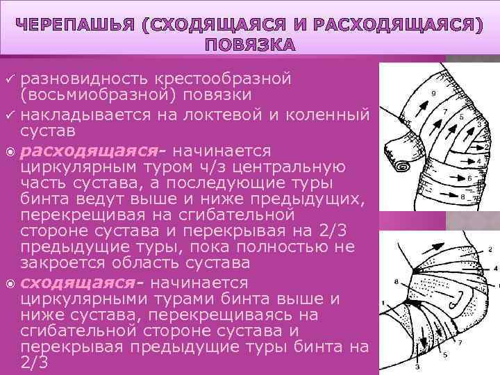 ЧЕРЕПАШЬЯ (СХОДЯЩАЯСЯ И РАСХОДЯЩАЯСЯ) ПОВЯЗКА разновидность крестообразной (восьмиобразной) повязки ü накладывается на локтевой и
