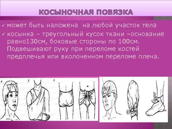 КОСЫНОЧНАЯ ПОВЯЗКА может быть наложена на любой участок тела ü косынка – треугольный кусок