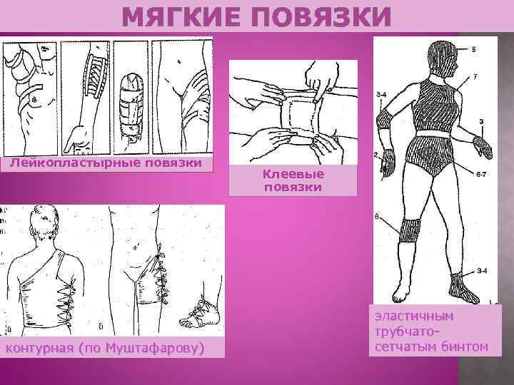 МЯГКИЕ ПОВЯЗКИ Лейкопластырные повязки контурная (по Муштафарову) Клеевые повязки эластичным трубчатосетчатым бинтом 