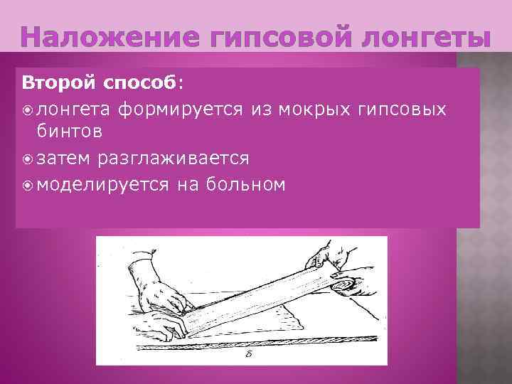 Наложение гипсовой лонгеты Второй способ: лонгета формируется из мокрых гипсовых бинтов затем разглаживается моделируется