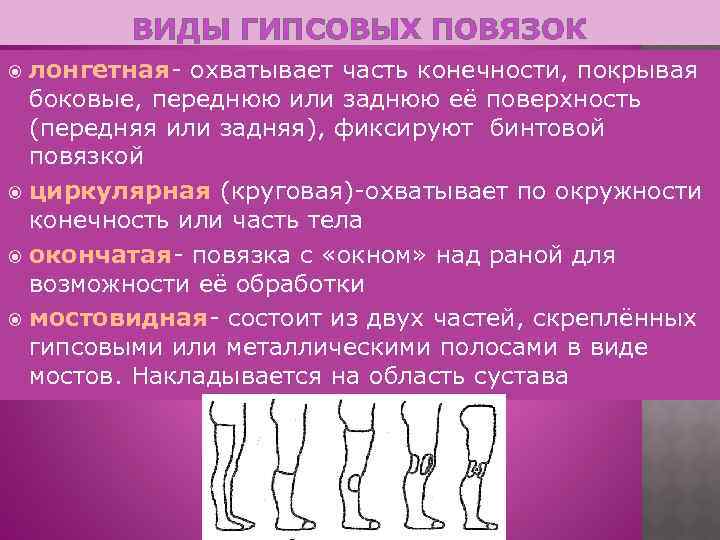 ВИДЫ ГИПСОВЫХ ПОВЯЗОК лонгетная- охватывает часть конечности, покрывая боковые, переднюю или заднюю её поверхность