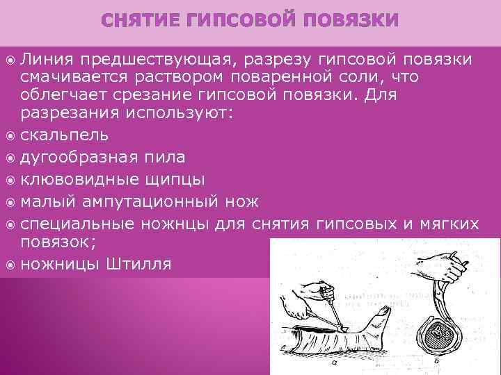 СНЯТИЕ ГИПСОВОЙ ПОВЯЗКИ Линия предшествующая, разрезу гипсовой повязки смачивается раствором поваренной соли, что облегчает