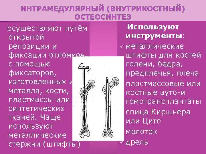 ИНТРАМЕДУЛЯРНЫЙ (ВНУТРИКОСТНЫЙ) ОСТЕОСИНТЕЗ осуществляют путём открытой репозиции и фиксации отломков с помощью фиксаторов, изготовленных