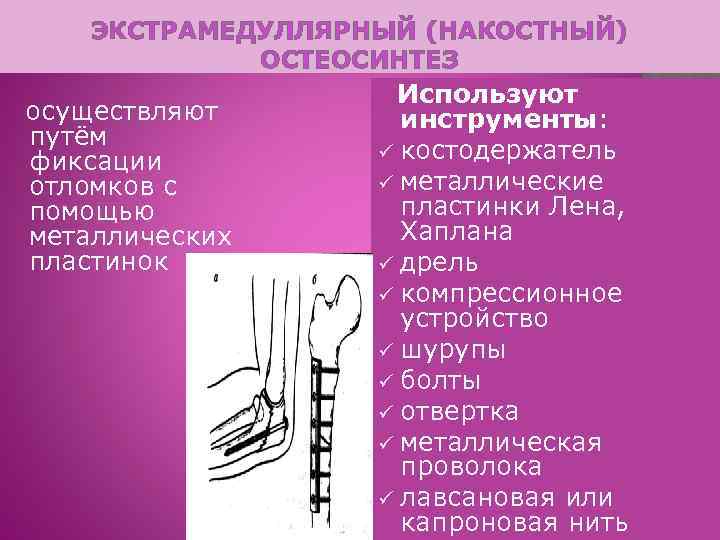 ЭКСТРАМЕДУЛЛЯРНЫЙ (НАКОСТНЫЙ) ОСТЕОСИНТЕЗ осуществляют путём фиксации отломков с помощью металлических пластинок Используют инструменты: ü