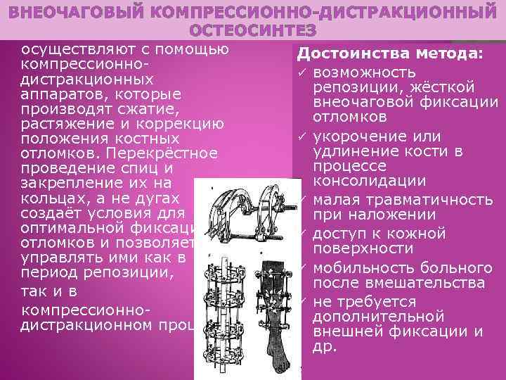 ВНЕОЧАГОВЫЙ КОМПРЕССИОННО-ДИСТРАКЦИОННЫЙ ОСТЕОСИНТЕЗ осуществляют с помощью Достоинства метода: компрессионноü возможность дистракционных репозиции, жёсткой аппаратов,