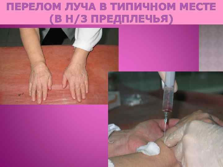 ПЕРЕЛОМ ЛУЧА В ТИПИЧНОМ МЕСТЕ (В Н/3 ПРЕДПЛЕЧЬЯ) 