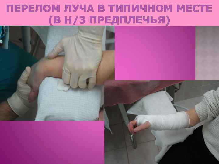 ПЕРЕЛОМ ЛУЧА В ТИПИЧНОМ МЕСТЕ (В Н/3 ПРЕДПЛЕЧЬЯ) 