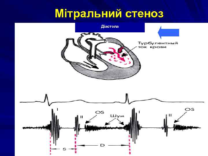 Мітральний стеноз Діастола 