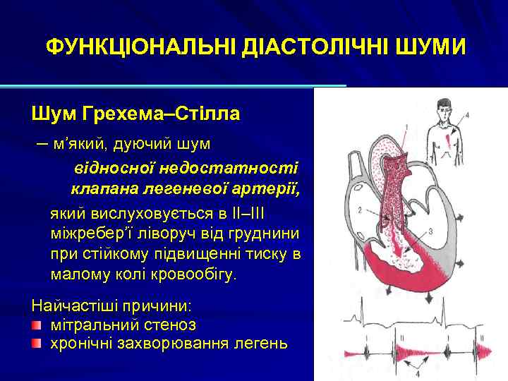 ФУНКЦІОНАЛЬНІ ДІАСТОЛІЧНІ ШУМИ Шум Грехема–Стілла – м’який, дуючий шум відносної недостатності клапана легеневої артерії,