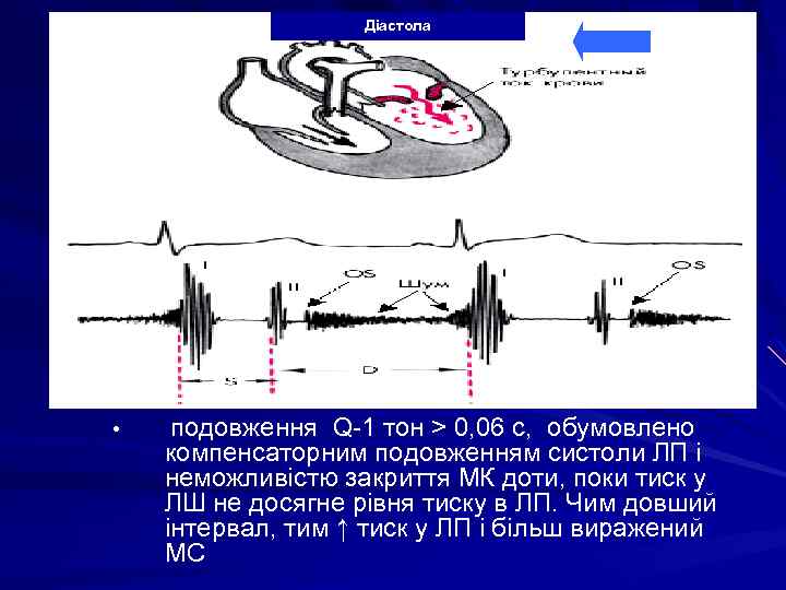 Діастола • подовження Q-1 тон > 0, 06 с, обумовлено компенсаторним подовженням систоли ЛП