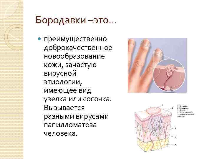 Бородавки –это… преимущественно доброкачественное новообразование кожи, зачастую вирусной этиологии, имеющее вид узелка или сосочка.