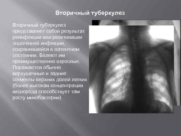 Вторичный туберкулез представляет собой результат реинфекции или реактивации эндогенной инфекции, сохранявшейся в латентном состоянии.